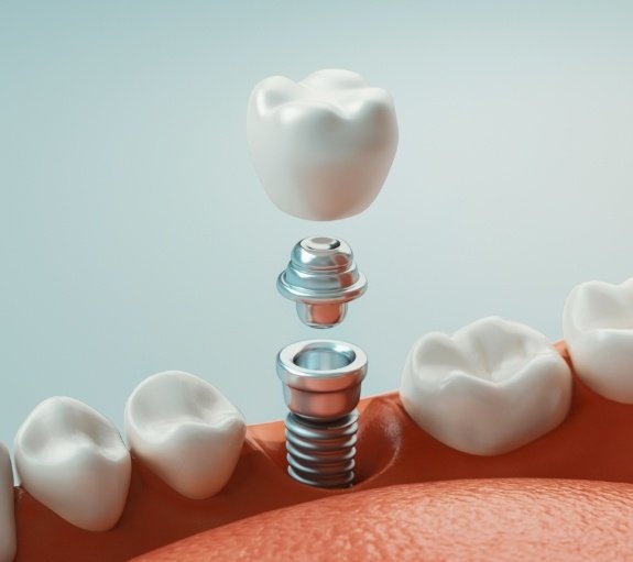 Illustration of dental implant abutment and crown being placed into the lower jaw