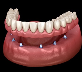 a computer graphic showing implant dentures in a mouth