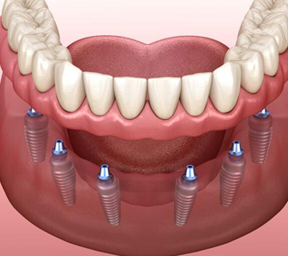 A 3D illustration of a denture being set over multiple dental implants